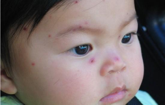 水痘可以吃白瓜吗,营养与健康的双重守护